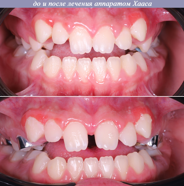 Расширение верхней челюсти при помощи аппарата Хааса