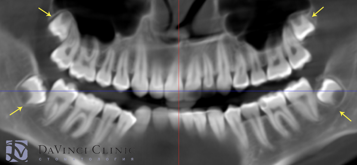 дистопия зубов мудрости